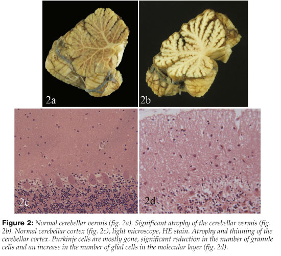 Alcoholic Cerebellar Degeneration