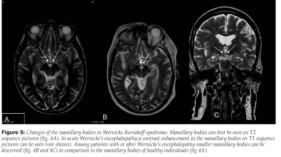 Alcoholic Cerebellar Degeneration