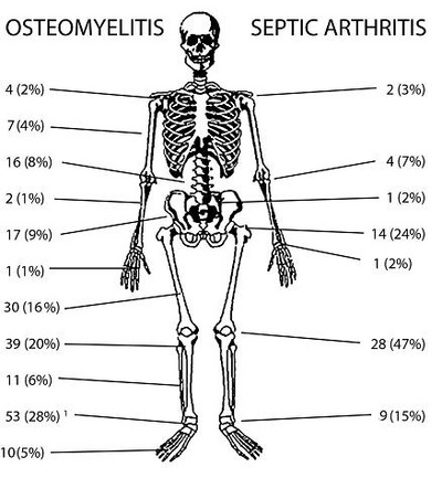 f03-Fig.-4-----Site-of-infection-in-osteomyelitis-and-septic-arthritis.-More-than-one-bone-may-be-infected-at-the-same-time.