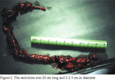 f04-fig2-Figure-2.-The-embolism-was-20-cm-long-and-2-2.5-cm-in-diameter.